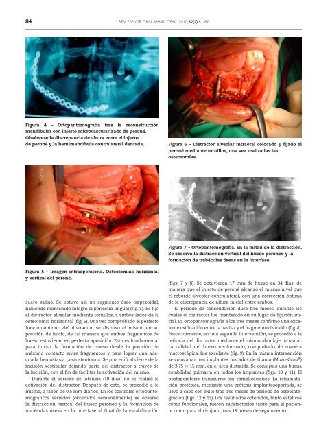 Cirugía Oral y Maxilofacial - SciELO España