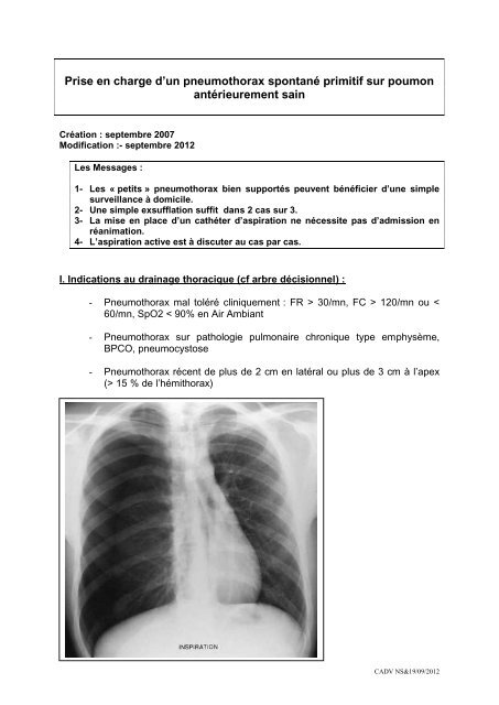 Prise en charge d'un pneumothorax spontané primitif sur poumon ...