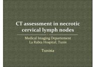 CT assessment in necrotic cervical lymph nodes