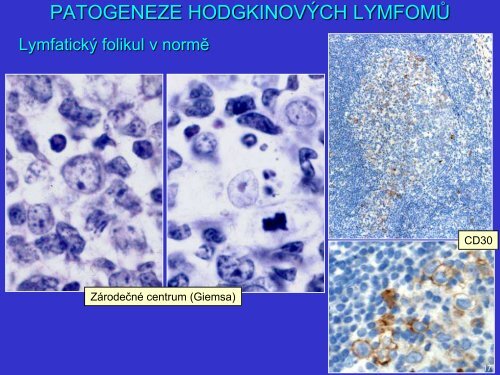 Patogeneze Hodgkinova lymfomu z pohledu patologa a klasifikace