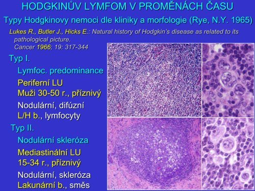 Patogeneze Hodgkinova lymfomu z pohledu patologa a klasifikace