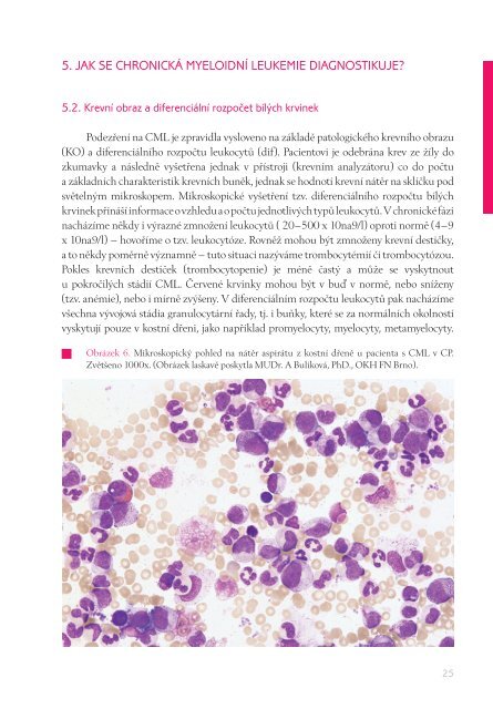 CHRONICKÁ MYELOIDNÍ LEUKEMIE - European Leukemia Net