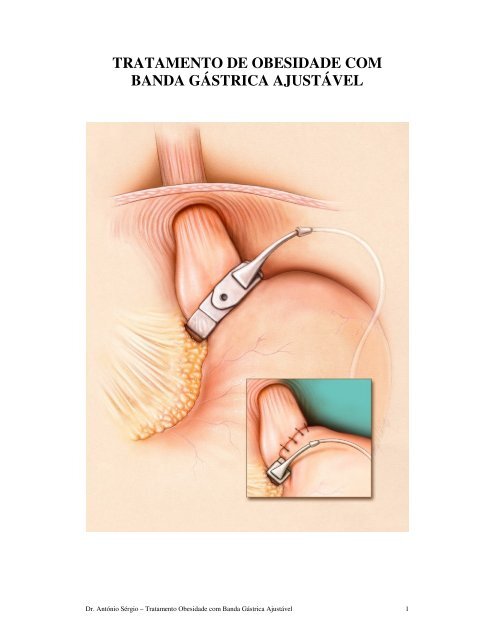 tratamento de obesidade com banda gástrica ajustável - Adexo