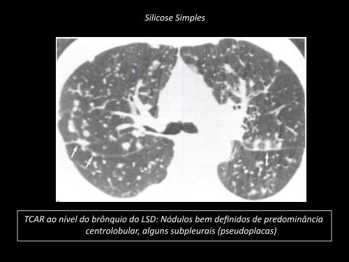 Doenças Pulmonares Ocupacionais - ANAMT