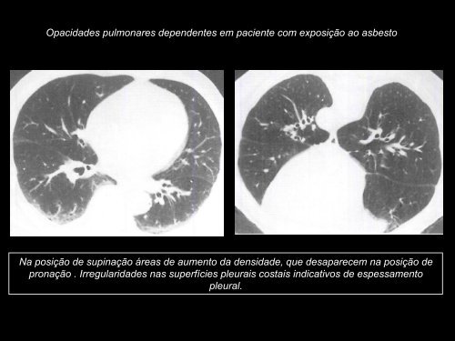 Doenças Pulmonares Ocupacionais - ANAMT