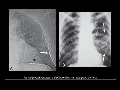 Doenças Pulmonares Ocupacionais - ANAMT