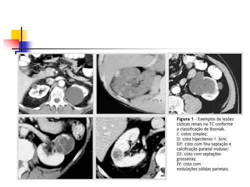 VOLUMOSAS MASSAS ABDOMINAIS