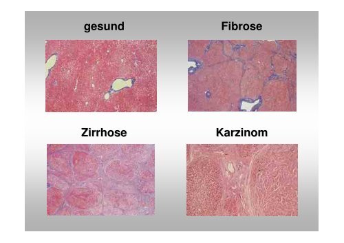 gesund Fibrose Zirrhose K