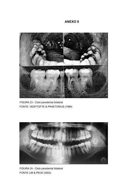 cisto paradental nomenclatura, etiologia, aspectos clínicos e ...