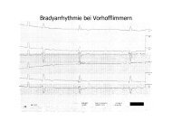 Bradyarrhythmie bei Vorhofflimmern - Zollernalb Klinikum gGmbH