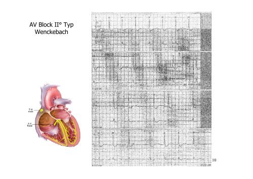 Typische EKG-Veränderungen erkennen - Zollernalb Klinikum gGmbH