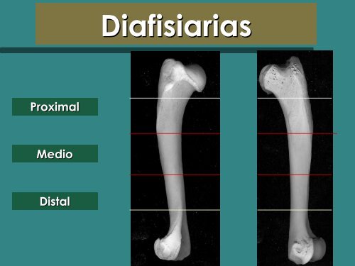 Clasificación de Fracturas