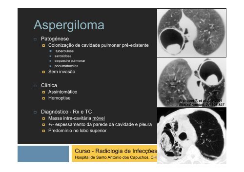 Aspergilose