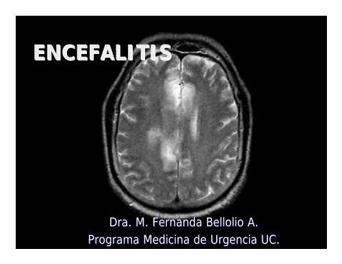 ENCEFALITIS - Medicina de Urgencia UC