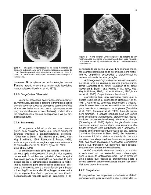 Complicações cirúrgicas das infecções bacterianas intracranianas