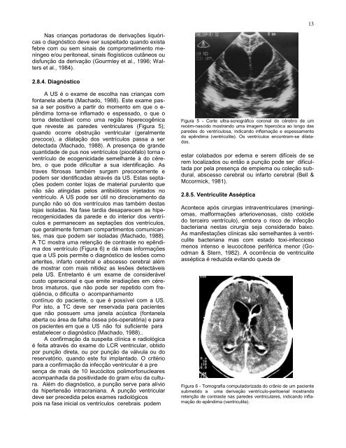 Complicações cirúrgicas das infecções bacterianas intracranianas