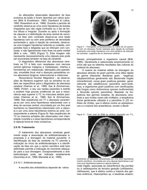 Complicações cirúrgicas das infecções bacterianas intracranianas