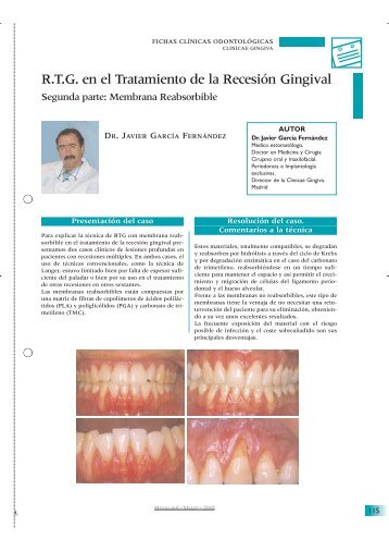 R.T.G. en el Tratamiento de la Recesión Gingival - Maxillaris