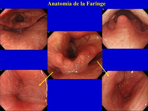 ERGE: Tratamiento Quirúrgico - Clínica de Gastroenterología.