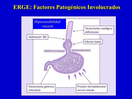 ERGE: Tratamiento Quirúrgico - Clínica de Gastroenterología.