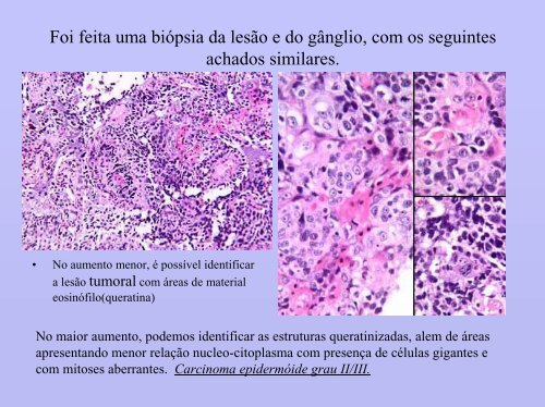 Gradação Histológica de tumores - medicina | celular