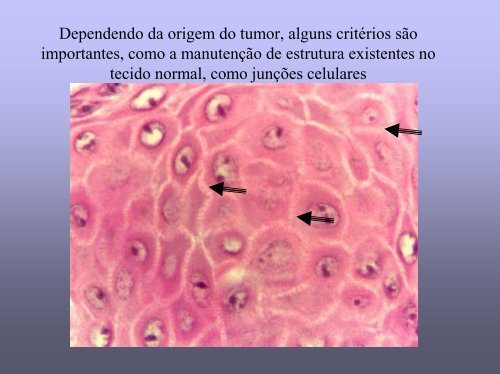 Gradação Histológica de tumores - medicina | celular