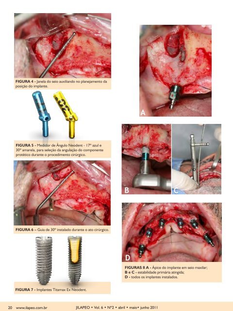 Caso de implantes angulados como opção reabilitadora ... - ILAPEO