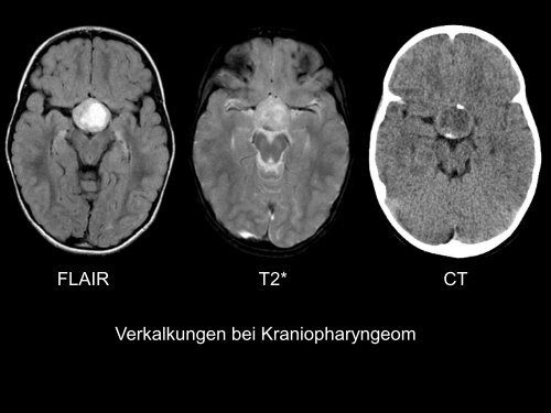 Neuroradiologie für Kinderärzte: CT und MRT