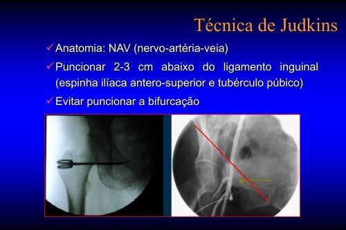 Vias de acesso arterial - SBHCI