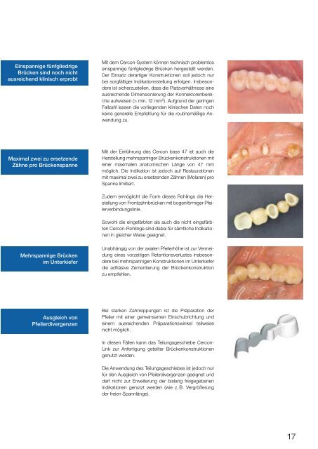 Cercon - Klinischer Leitfaden - Dental-Labor Hans Fuhr GmbH & Co ...