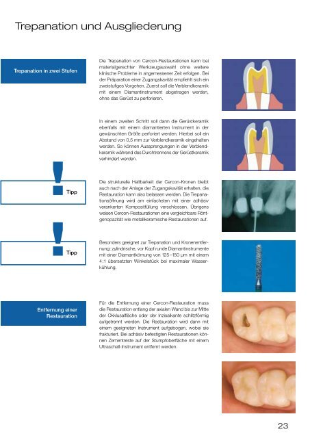 Cercon - Klinischer Leitfaden - Dental-Labor Hans Fuhr GmbH & Co ...