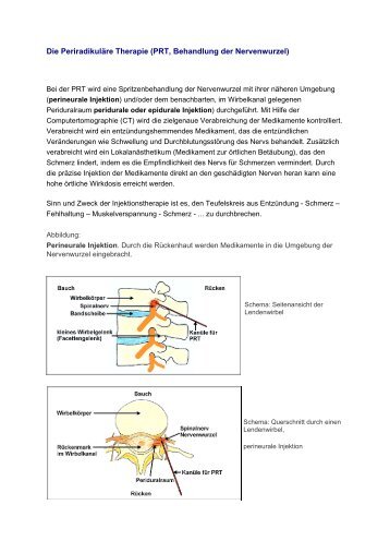 Die Periradikuläre Therapie (PRT, Behandlung der Nervenwurzel)