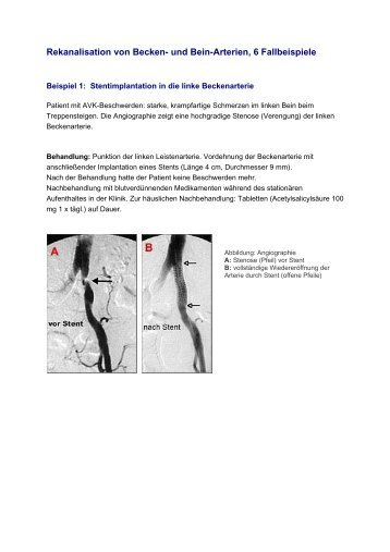 Rekanalisation von Becken- und Bein-Arterien, 6 Fallbeispiele