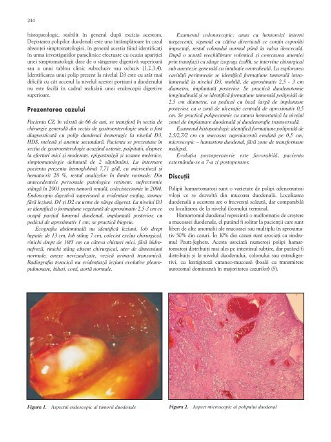 Polip hamartomatos duodenal unic - prezentare de caz ... - Chirurgia