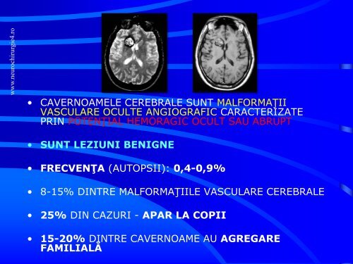 Actualitati in managementul cavernoamelor cerebrale