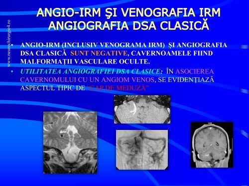 Actualitati in managementul cavernoamelor cerebrale