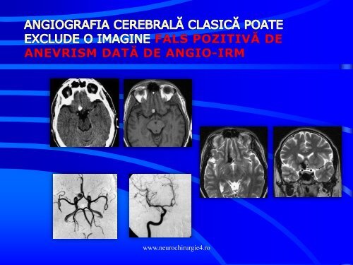 Actualitati in managementul cavernoamelor cerebrale