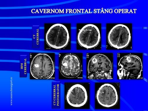 Actualitati in managementul cavernoamelor cerebrale