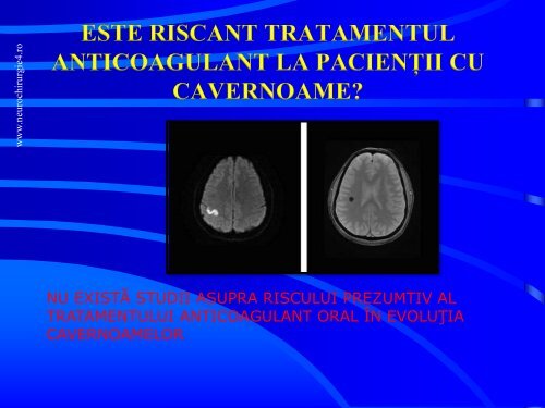 Actualitati in managementul cavernoamelor cerebrale