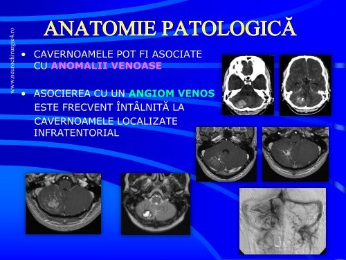 Actualitati in managementul cavernoamelor cerebrale