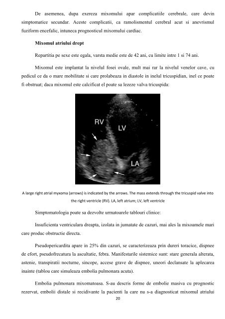 Tumorile cardiopericardice Prof Dr Grigore Tinica, Dr. Lutea Mirela ...