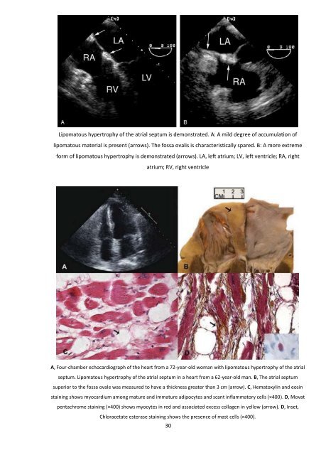 Tumorile cardiopericardice Prof Dr Grigore Tinica, Dr. Lutea Mirela ...