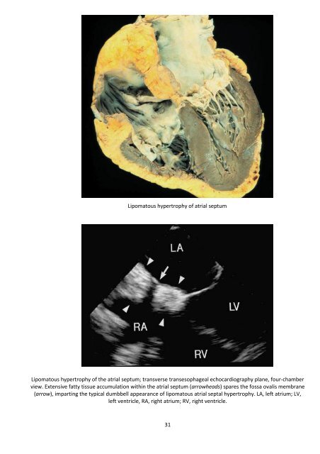 Tumorile cardiopericardice Prof Dr Grigore Tinica, Dr. Lutea Mirela ...