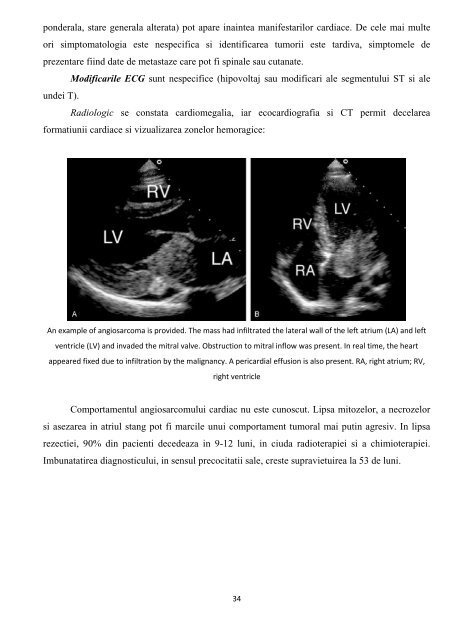 Tumorile cardiopericardice Prof Dr Grigore Tinica, Dr. Lutea Mirela ...