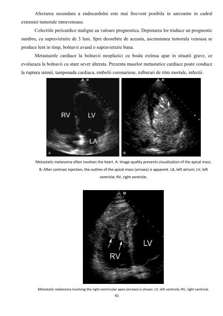 Tumorile cardiopericardice Prof Dr Grigore Tinica, Dr. Lutea Mirela ...