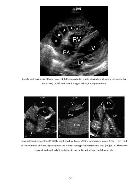 Tumorile cardiopericardice Prof Dr Grigore Tinica, Dr. Lutea Mirela ...