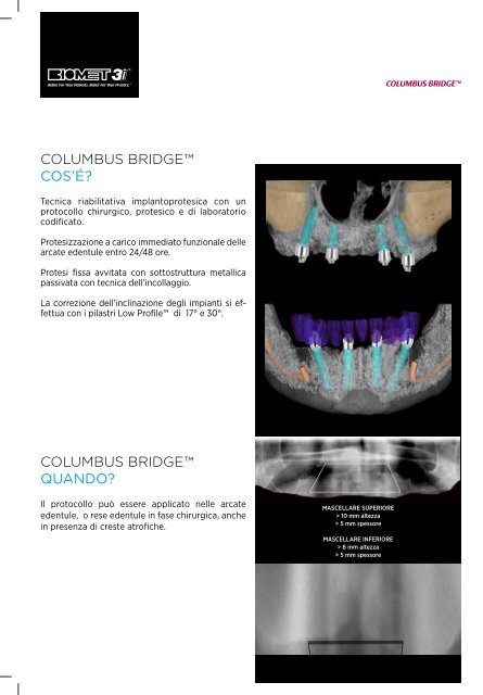 COLUMBUS BRIDGE™ - Biomax