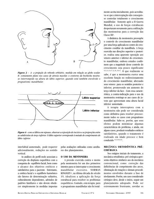 Tratamento Ortodôntico-Cirúrgico da Classe III - Dental Press