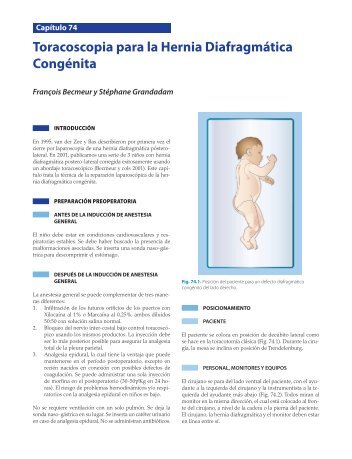 Toracoscopia para la Hernia Diafragmática Congénita - Axon