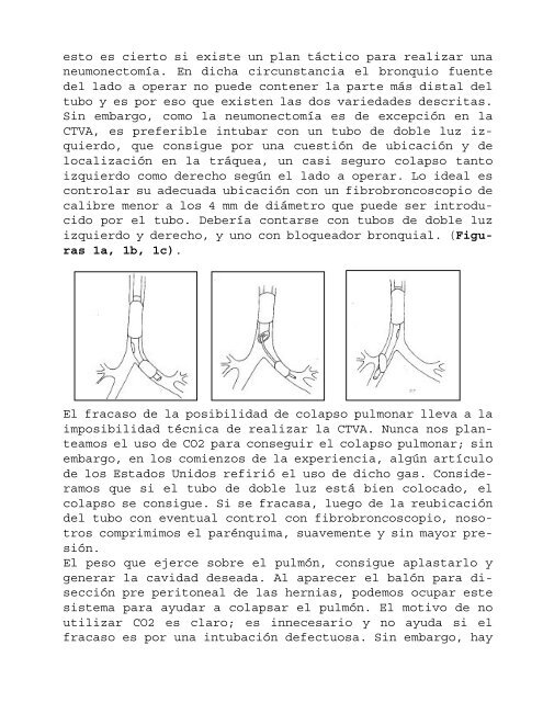 CIRUGIA TORACICA VIDEO ASISTIDA (CTVA).